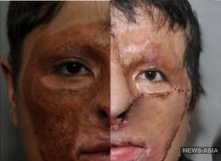 Киргизские врачи провели уникальную операцию по пересадке кожи лица