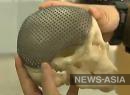 Титановая пластина которая заменила часть черепа